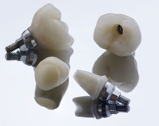 Teeth Implants